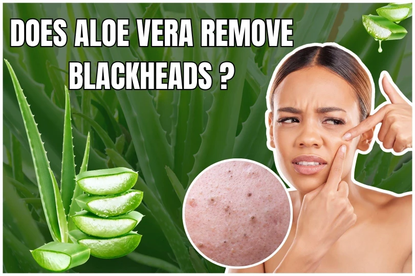 does aloe vera remove blackheads